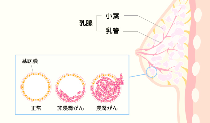 乳がん